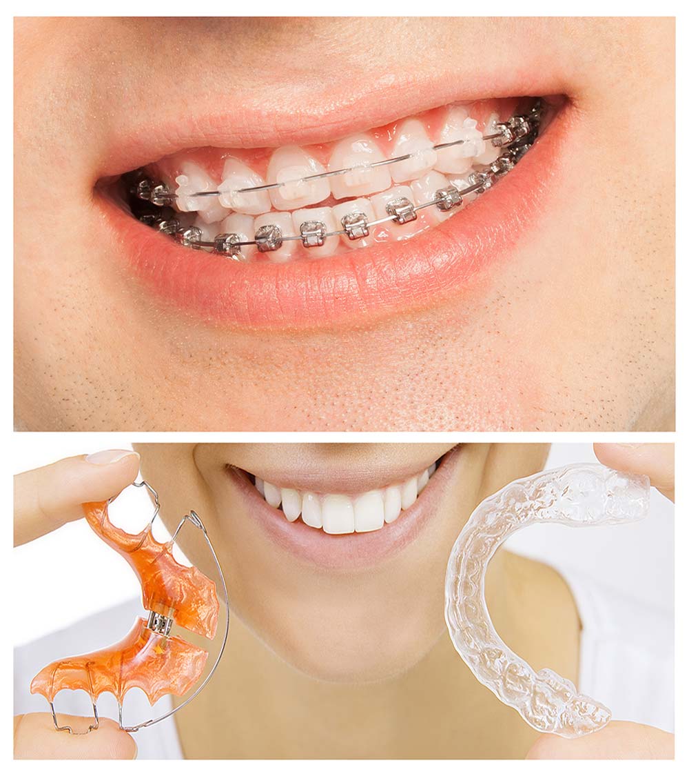 Braces And Invisalign Siam Station Dental Clinic